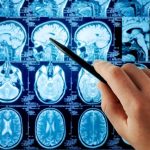 imagen del artículo: Neurología sin Neurólogo
