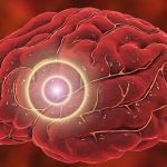 imagen del artículo: ¿Migraña… o aneurisma?